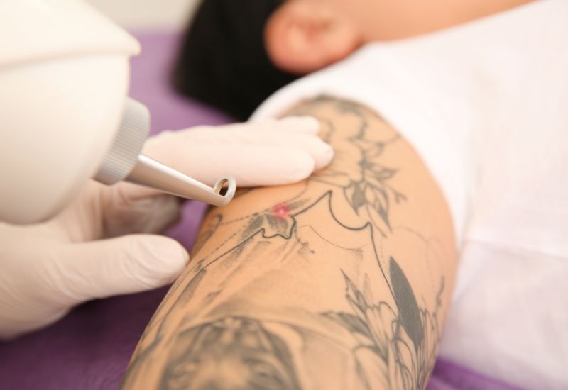 Laser odstranění tetování