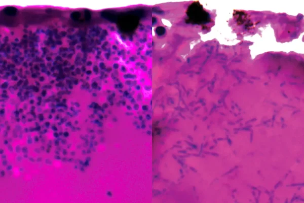Vědci objevili slabé místo smrtící houby, která uzavřela nemocniční jednotky intenzivní péče