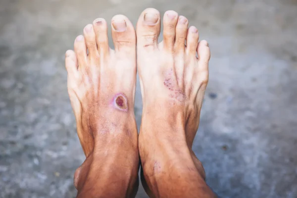 Globální studie DNA odhaluje skrytou hrozbu v infekcích diabetických nohou