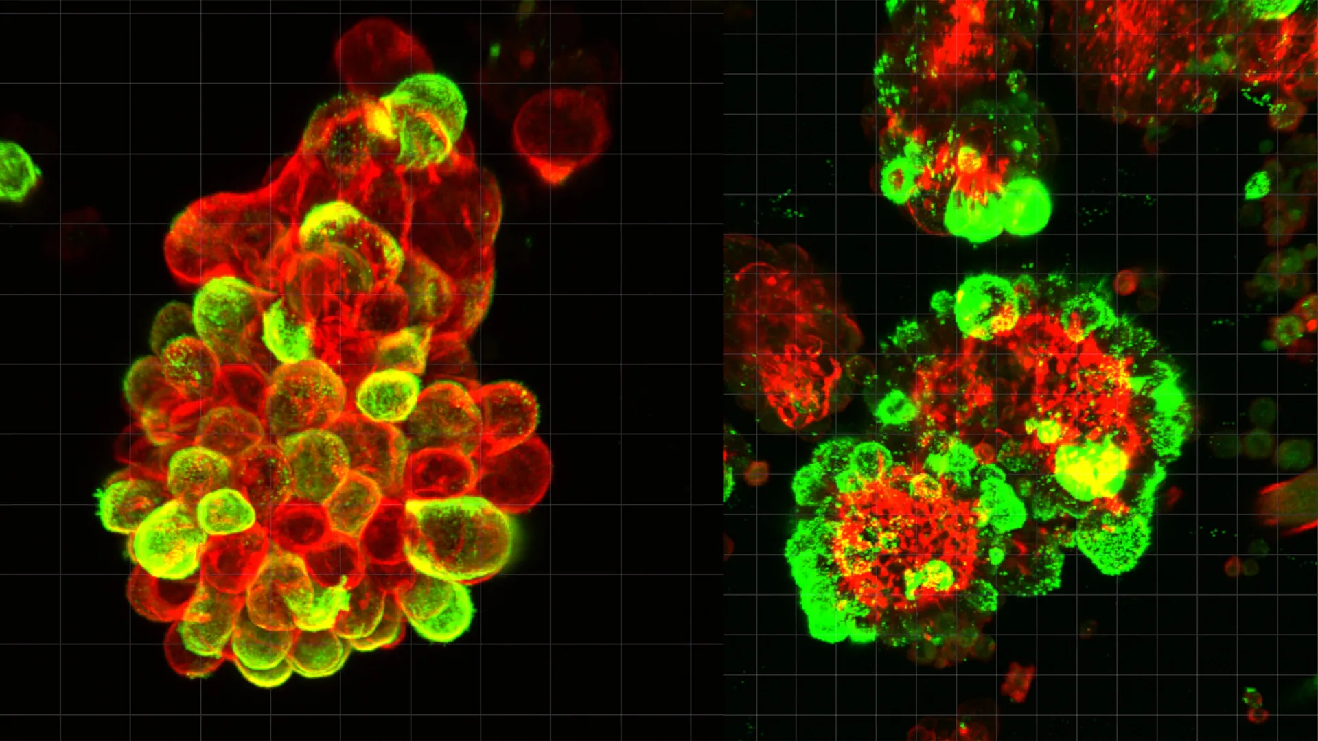 Tajemná buněčná aliance může vysvětlit, proč je rakovina vaječníků tak smrtelná