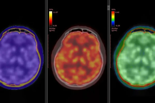 Skeny mozku odhalují, jak ketamin rychle zmírňuje těžkou depresi