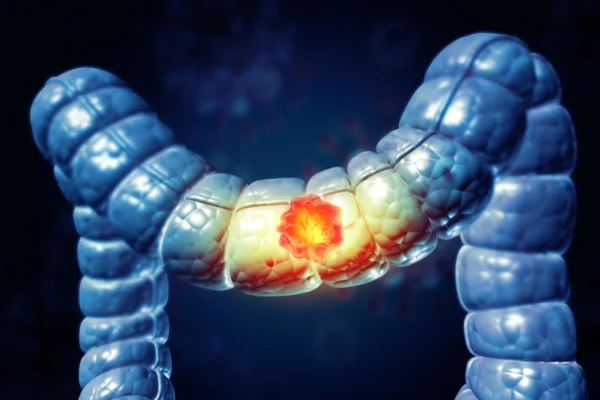 Většina Američanů neví, že tato potravina zvyšuje riziko rakoviny tlustého střeva