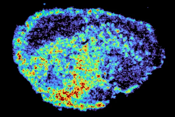 Vědci objevili, proč léky na rakovinu nefungují u všech pacientů