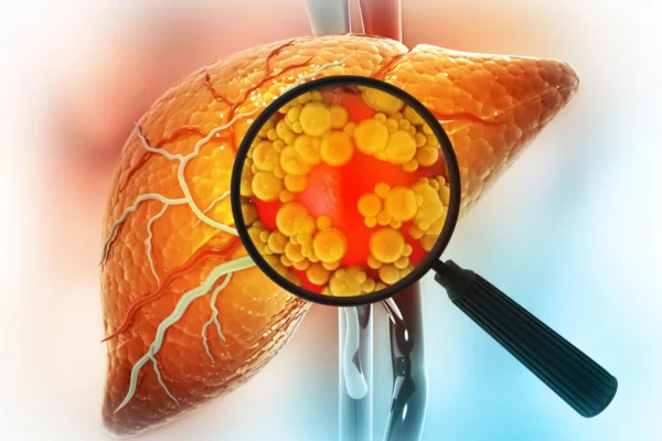Nadějná léčba tukové jaterní choroby může zvýšit riziko rakoviny