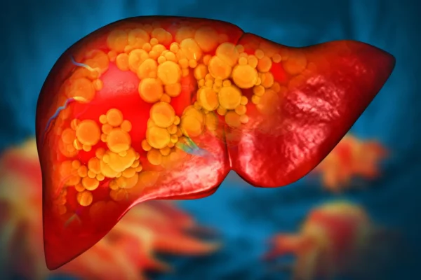 Konzumace alkoholu jednou měsíčně může ztrojnásobit riziko zjizvení jater