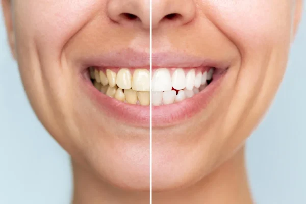 Nový zubní prášek bělí zuby bez poškození