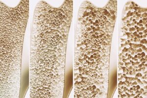 Když neznámý receptor může změnit boj s osteoporózou