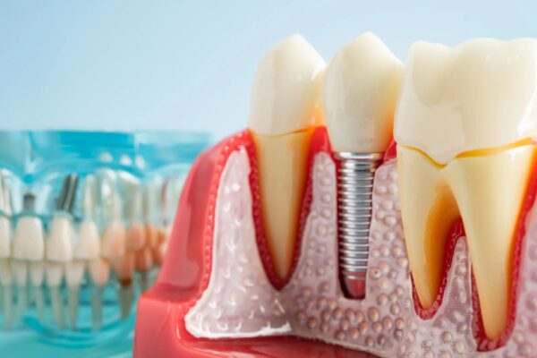 Titanové implantáty: Nečekaný
